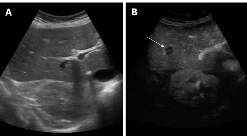 baseline ultrasound ivf 