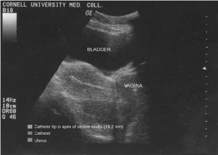 embryo transfer pelvic ultrasound