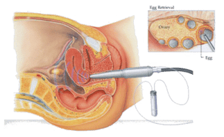 ivf fertilization procedure