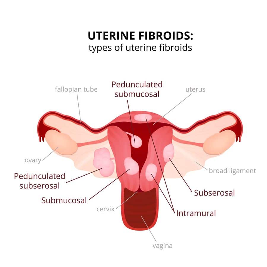 uterine-fibroids