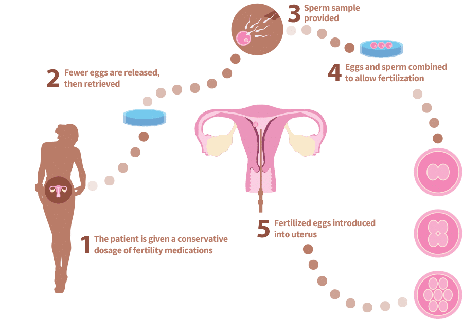 Mini Ivf 