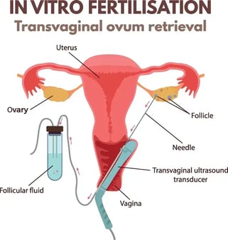 reciprocal IVF egg retrieval process graphic